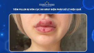 Tiêm filler bị vón cục do đâu? Biện pháp xử lý hiệu quả 36 tiêm filler bị vón cục