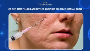 Có nên tiêm filler làm đầy sẹo lõm không? Địa chỉ thực hiện an toàn 38 tiêm filler làm đầy sẹo lõm