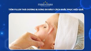 Tiêm filler thái dương bị sưng do đâu? Cách khắc phục hiệu quả 76 tiêm filler thái dương bị sưng