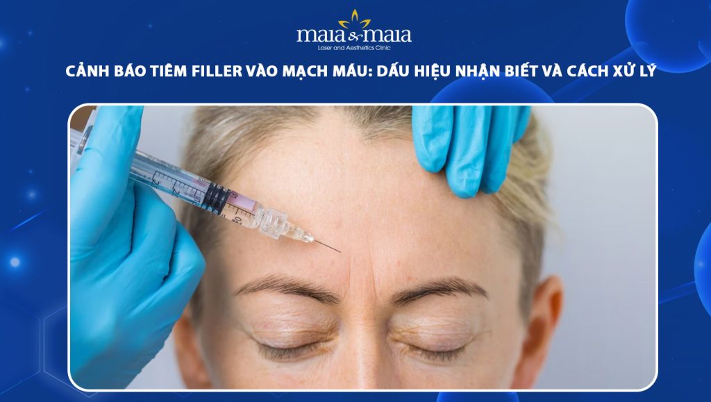 Cảnh báo tiêm filler vào mạch máu: Dấu hiệu nhận biết và cách xử lý 1 tiêm filler vào mạch máu