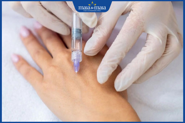 Tiêm filler bàn tay: Giải pháp trẻ hóa tay an toàn, hiệu quả  2 tiêm filler vào tay