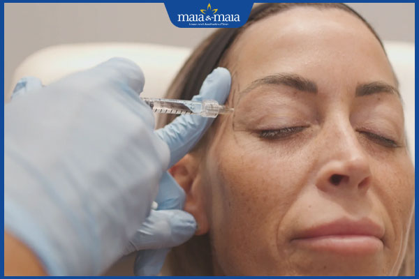 Tiêm filler thái dương: Giải pháp cho gương mặt đầy đặn, trẻ trung 7 tiêm filler vào thái dương