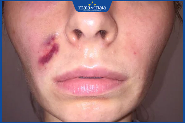 Tiêm filler xong bị cứng phải làm sao? Phòng ngừa như thế nào? 2 tiêm filler xong bị bầm tím