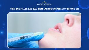 Tiêm tan filler bao lâu tiêm lại được? Cần lưu ý những gì? 86 tiêm tan filler bao lâu tiêm lại được