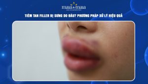 Tiêm tan filler bị sưng do đâu? Phương pháp xử lý hiệu quả 62 tiêm tan filler bị sưng