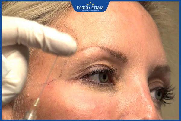 Tiêm filler thái dương: Giải pháp cho gương mặt đầy đặn, trẻ trung 4 tiến hành tiêm filler thái dương
