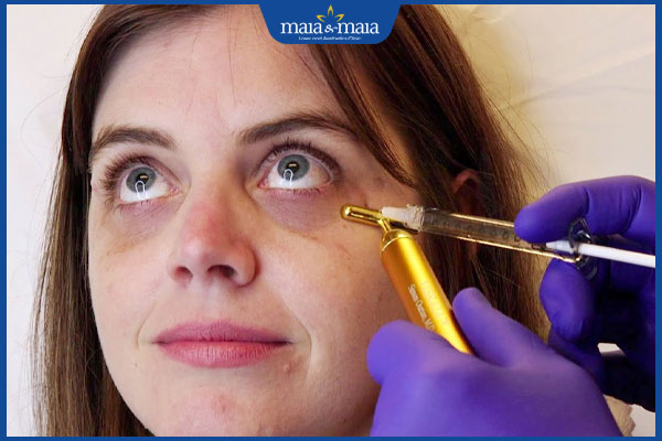 Tiêm thâm quầng mắt: Giải pháp trẻ hóa đôi mắt đẹp tự nhiên 4 tiến hành tiêm quầng thâm mắt