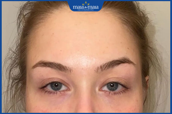 Tiêm filler thái dương: Giải pháp cho gương mặt đầy đặn, trẻ trung 3 tình trạng thái dương bị hóp