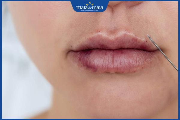 tư vấn thời gian tiêm tan filler