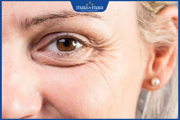 Tiêm Meso Extra có tác dụng gì? Liệu trình tiêm chuẩn y khoa 3 vết chân chim