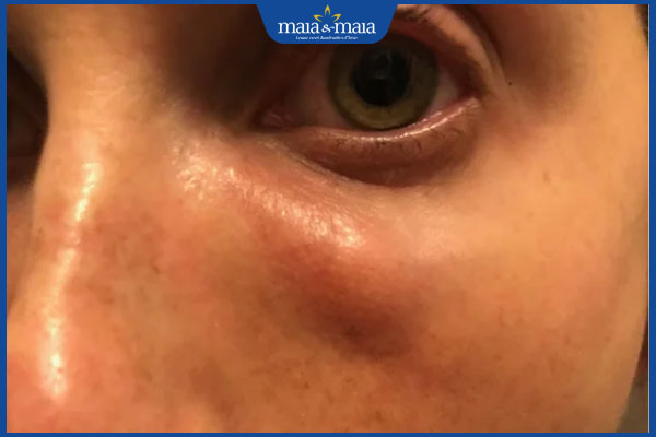 Tiêm filler bị vón cục do đâu? Biện pháp xử lý hiệu quả 2 vón cục sau tiêm filler