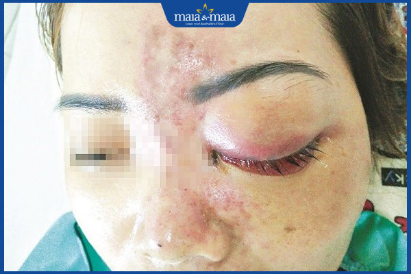 Tiêm filler giá rẻ tiềm ẩn những nguy hiểm gì? 3 mù lòa sau tiêm