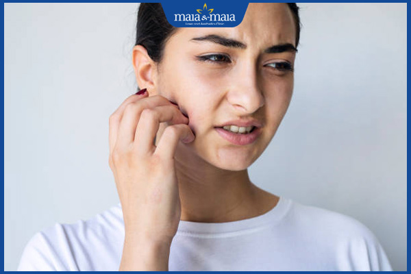 Biến chứng tiêm filler má theo từng cấp độ và cách xử lý an toàn 2 ngứa rát sau tiêm