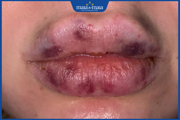 Tiêm filler má giá bao nhiêu? Rủi ro khi tiêm filler má giá rẻ 3 biến chứng tiêm filler má giá rẻ