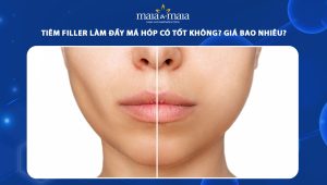 Tiêm filler làm đầy má hóp có tốt không? Giá bao nhiêu? 58 tiêm filler làm đầy má hóp