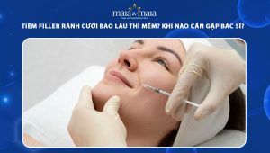 Tiêm filler rãnh cười bao lâu thì mềm? Khi nào cần gặp bác sĩ? 34 tiêm filler rãnh cười bao lâu thì mềm