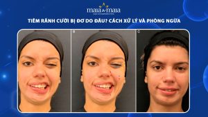 Tiêm rãnh cười bị đơ do đâu? Cách xử lý và phòng ngừa 85 tiêm rãnh cười bị đơ