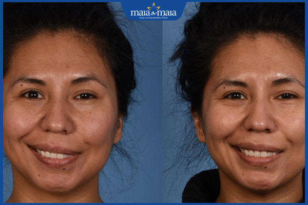 tình trạng tiêm rành cười bị đơ