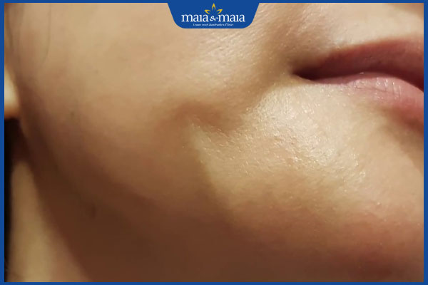 Tổng hợp các tác hại căng da mặt bằng chỉ ít ai ngờ tới 2 biến chứng căng da mặt bằng chỉ