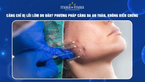 Căng chỉ bị lồi lõm do đâu? Phương pháp căng da an toàn, không biến chứng 28 Căng chỉ bị lồi lõm