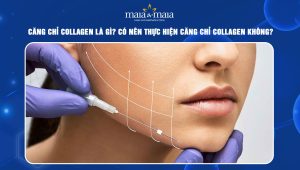 Căng chỉ collagen là gì? Có nên thực hiện căng chỉ collagen không? 50 căng chỉ collagen