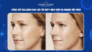 Căng chỉ collagen bao lâu thì đẹp? Mẹo giúp da nhanh hồi phục 32 Căng chỉ collagen bao lâu thì đẹp