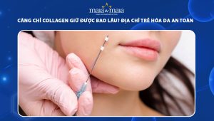 Căng chỉ collagen giữ được bao lâu? Địa chỉ trẻ hóa da an toàn 42 căng chỉ collagen giữ được bao lâu