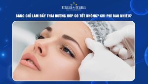 Căng chỉ làm đầy thái dương hóp có tốt không? Chi phí bao nhiêu? 64 Căng chỉ làm đầy thái dương hóp