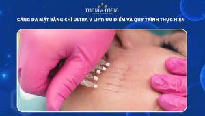 Căng da mặt bằng chỉ Ultra V Lift: Ưu điểm và quy trình thực hiện 36 căng da mặt bằng chỉ Ultra V Lift