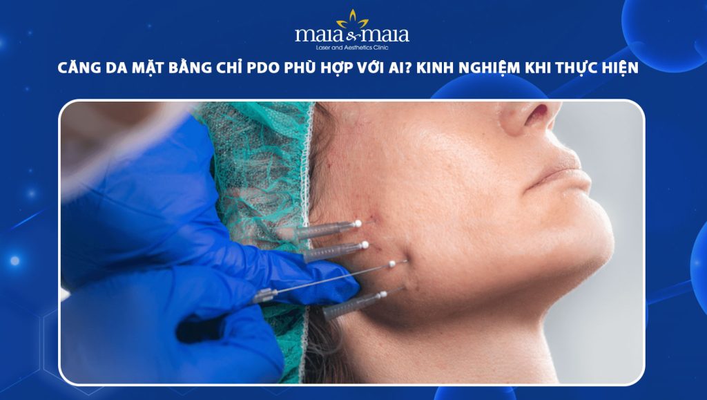 căng da mặt bằng chỉ pdo