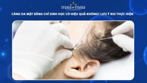 Căng da mặt bằng chỉ sinh học có hiệu quả không? Lưu ý khi thực hiện 51 căng da mặt bằng chỉ sinh học