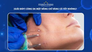 Căng da mặt bằng chỉ vàng có tốt không