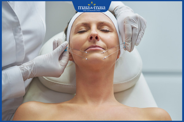 cấy chỉ collagen