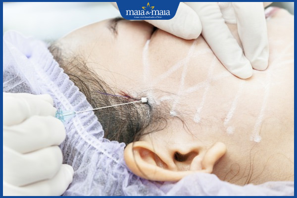 Căng chỉ làm đầy thái dương hóp có tốt không? Chi phí bao nhiêu? 2 cấy chỉ vùng thái dương