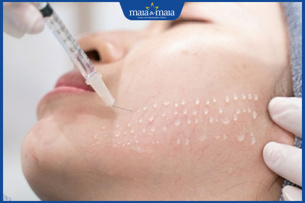 phương pháp tiêm meso