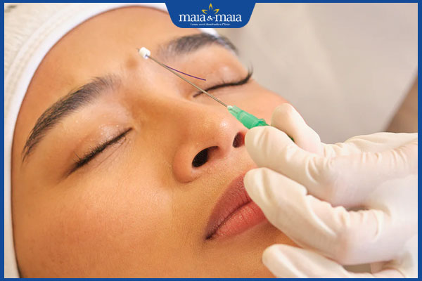 Căng da mặt bằng chỉ Ultra V Lift: Ưu điểm và quy trình thực hiện 4 quá trình căng da mặt bằng chỉ Ultra V Lift