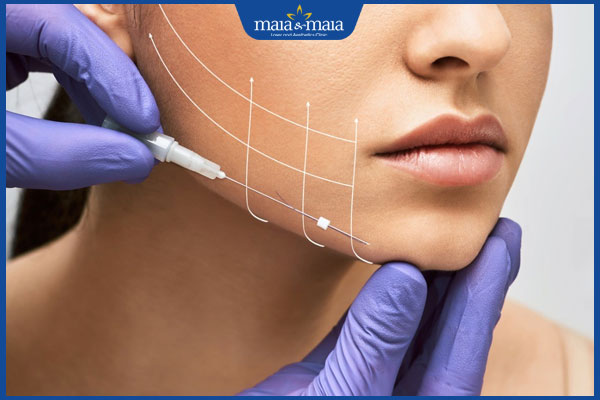 Căng da mặt bằng chỉ sinh học có hiệu quả không? Lưu ý khi thực hiện 4 quy trình căng da mặt bằng chỉ