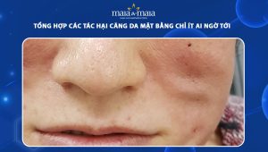 Tổng hợp các tác hại căng da mặt bằng chỉ ít ai ngờ tới 63 tác hại căng da mặt bằng chỉ