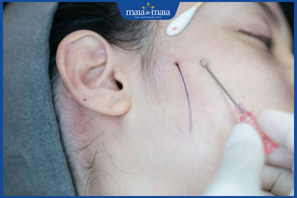 Điểm danh tác hại của căng chỉ collagen không ai ngờ tới!  2 thực hiện căng chỉ collagen