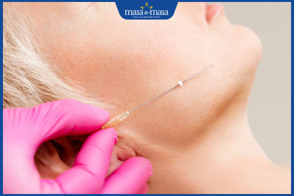 thực hiện căng da mặt bằng chỉ