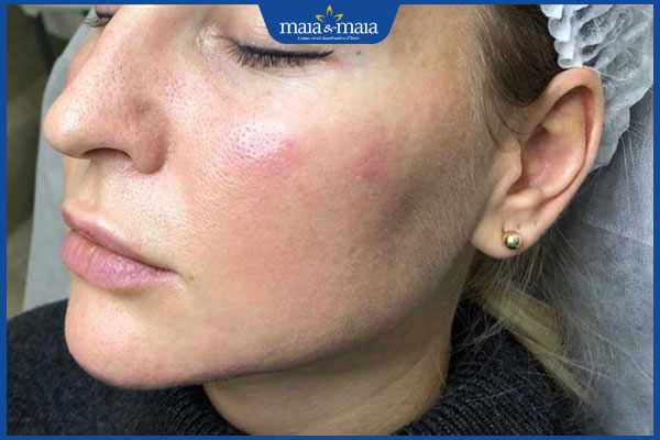 biểu hiện sau tiêm meso