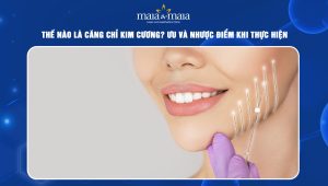 Thế nào là căng chỉ kim cương? Ưu và nhược điểm khi thực hiện 41 căng chỉ kim cương