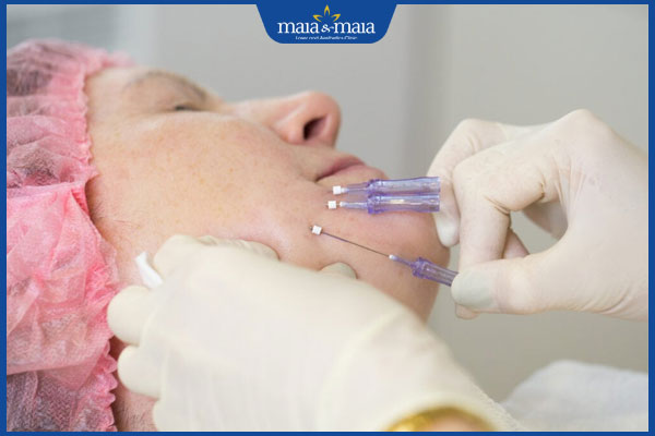 Điểm danh 10+ cách xóa nếp nhăn giúp làn da trẻ mãi 7 chi phí thực hiện căng chỉ pcl