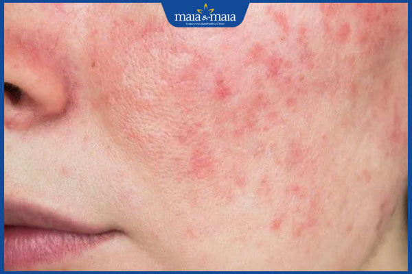 Chuyên gia giải đáp da nhiễm corticoid có tiêm meso được không? 2 da bị nhiễm corticoid