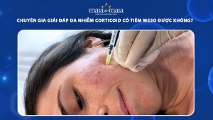 Chuyên gia giải đáp da nhiễm corticoid có tiêm meso được không? 64 da nhiễm corticoid có tiêm meso được không