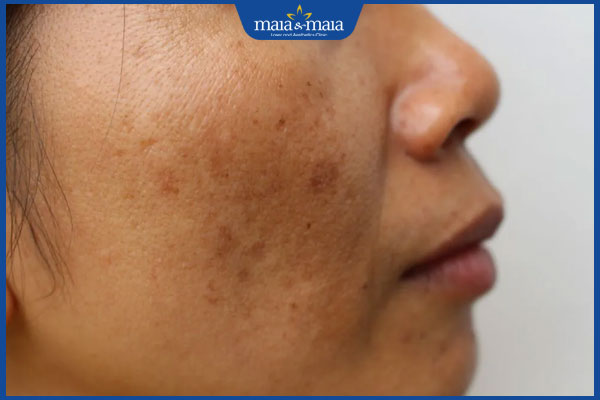 Thế nào là vi kim tảo biển? Hiệu quả làm đẹp có tốt như lời đồn? 4 làn da xỉn màu