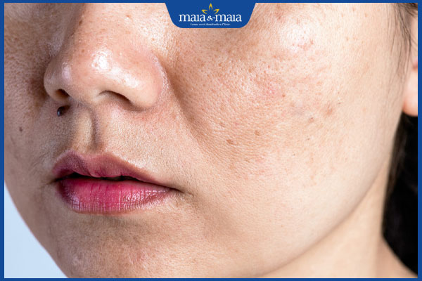 Peel da: Bí quyết sở hữu da căng bóng, mịn màng không tì vết 4 người có lỗ chân lông to