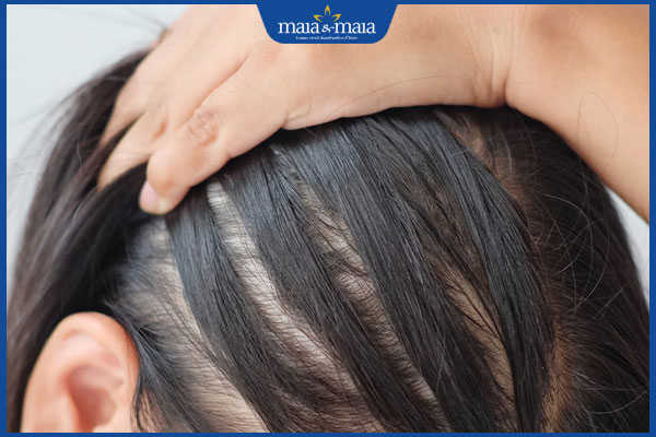 người tóc mỏng