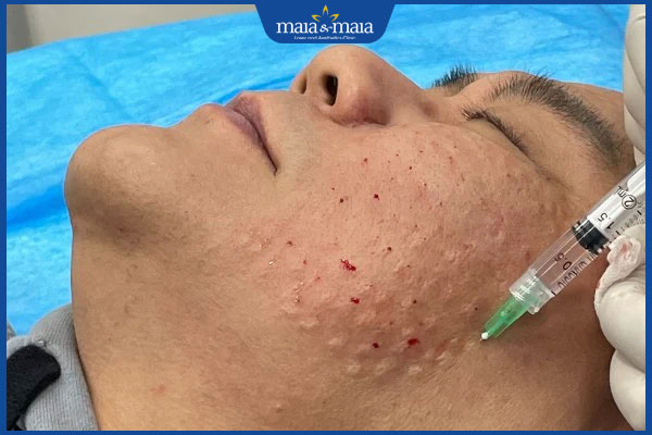 Tiêm Meso Extra có tác dụng gì? Liệu trình tiêm chuẩn y khoa 6 nổi u hạt sau tiêm meso