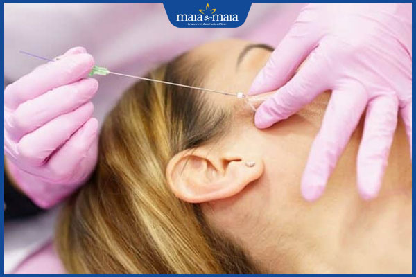 Căng chỉ PCL có an toàn không? Cảnh báo những rủi ro tiềm ẩn khi làm đẹp 2 thực hiện căng chỉ pcl